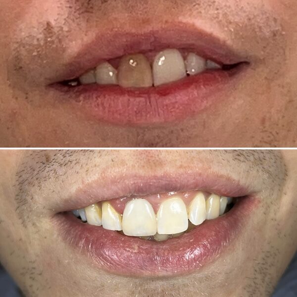 Užmaskuotas patamsėjęs dantis atlikus estetinį plombavimą