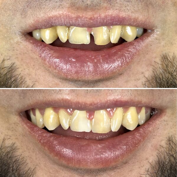 Atstatytas priekinis dantis po traumos