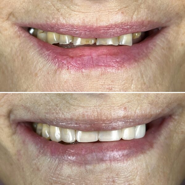 Nudilusių dantų estetinis plombavimas - atstatyta naturali forma ir parinkta spalva