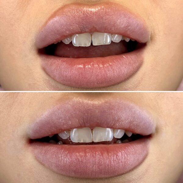 Atliktas estetinis plombavimas uždarant tarpą tarp dantų