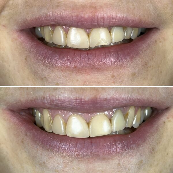 Su plomba atstatytas nudilęs danties kandamasis kraštas