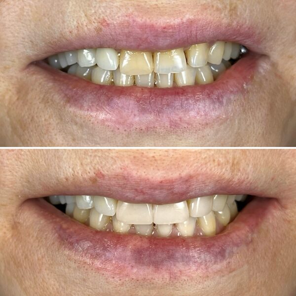 Estetinis plombavimas - pašalintos senos plombos, atstatyta naturali forma ir spalva