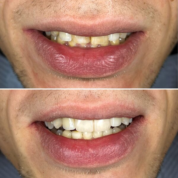 Estetinis plombavimas - pašalintos senos plombos, atstatyta forma su naturalia spalva